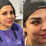 خدمات تخصصی کاشت ابرو نیوکاشت مرادی در آمل 