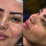 خدمات تخصصی کاشت ابرو نیوکاشت مرادی در آمل 