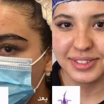 خدمات تخصصی کاشت ابرو نیوکاشت مرادی در آمل 