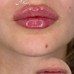 مرکز تخصصی ژل و بوتاکس رز نیو فیس در نسیم شهر