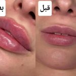 کلینیک فیلر بادی و فول فیس نادینا در کرج