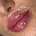 مرکز تخصصی ژل و بوتاکس رز نیو فیس در نسیم شهر