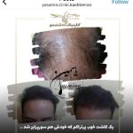کلینیک تخصصی کاشت مو و ابرو یاسمین در سپاهانشهر اصفهان