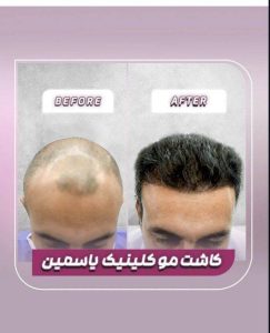 مشاهده کلینیک تخصصی کاشت مو و ابرو یاسمین در سپاهانشهر اصفهان در سامانه بهبود مشاغل