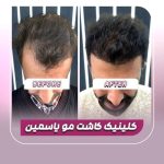کلینیک تخصصی کاشت مو و ابرو یاسمین در سپاهانشهر اصفهان