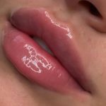 خدمات تخصصی ژل و بوتاکس نازنین سالاری در بندرعباس
