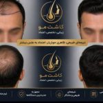 مرکز کاشت مو آیدینی در ائل گلی تبریز