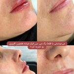 خدمات تخصصی ژل و بوتاکس حانی نیوفیس در شهر قدس