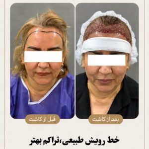 مشاهده کلینیک تخصصی مو رسول زاده بحرینی در امیری آبادان در سامانه بهبود مشاغل