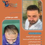 خدمات کاشت مو مفتاحی در خاکشناسی شیراز