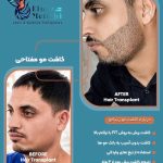 خدمات کاشت مو مفتاحی در خاکشناسی شیراز