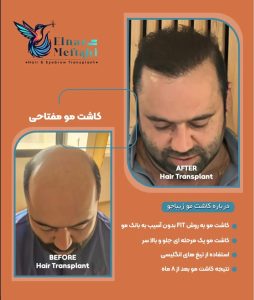 مشاهده خدمات کاشت مو مفتاحی در خاکشناسی شیراز در سامانه بهبود مشاغل