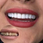 خدمات کامپوزیت دندان دنتا شهلا در نادری اهواز