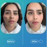 مرکز تزریق فیلر بادی برنا در اصفهان