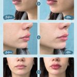 مرکز تزریق فیلر بادی برنا در اصفهان