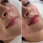 مرکز تزریق فیلر بادی برنا در اصفهان