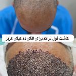 کلینیک تخصصی کاشت مو جوانه در ولیعصر تبریز