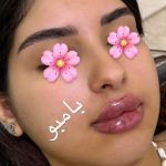 خدمات تخصصی ژل و بوتاکس نرگس سیاحت در زنبیل آباد قم