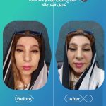 مرکز تزریق فیلر بادی برنا در اصفهان