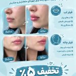 مرکز تزریق فیلر بادی برنا در اصفهان
