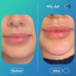 مرکز تزریق فیلر بادی برنا در اصفهان